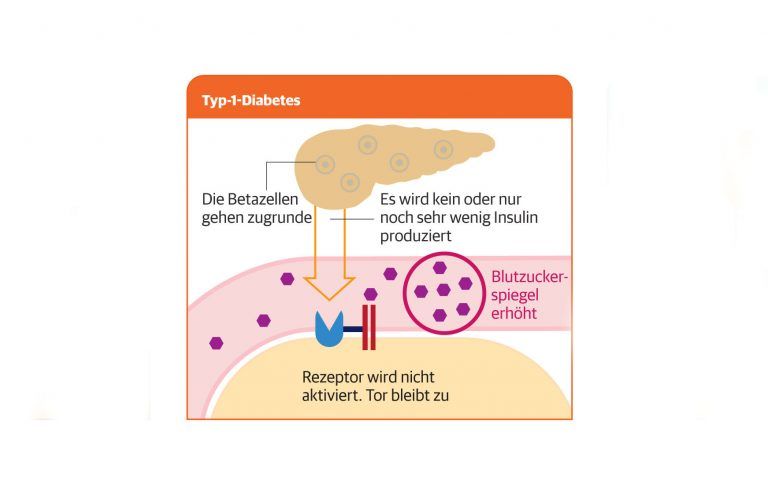 Erklärung wie die Insulinproduktion bei Diabetes gestört ist