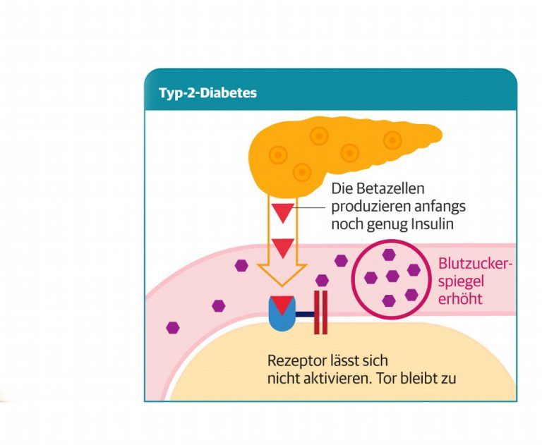 Erklärung wie die Insulinproduktion bei Diabetes 2 gestört ist