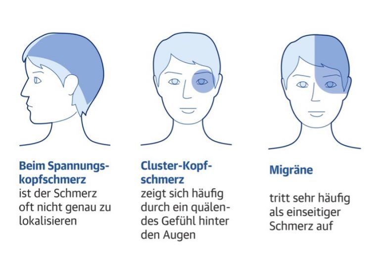 Drei Köpfe mit Markierung wo am Kopf die verschiedenen Kopfschmerzen auftreten. Spannungskopfschmerz, Cluster-Kopfschmerz, Migräne